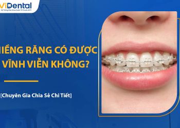 Niềng Răng Có Được Vĩnh Viễn Không? Chuyên Gia Giải Đáp