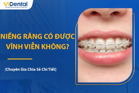 Niềng Răng Có Được Vĩnh Viễn Không? Chuyên Gia Giải Đáp