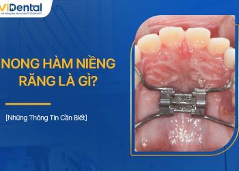 Nong Hàm Niềng Răng Là Gì? Những Thông Tin Cần Lưu Ý