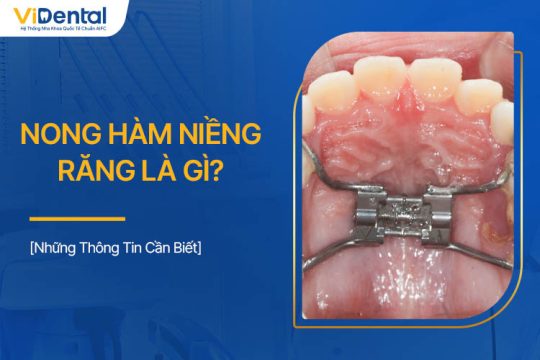 Nong Hàm Niềng Răng Là Gì? Những Thông Tin Cần Lưu Ý