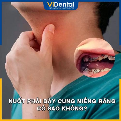 Nuốt dây cung niềng răng gây ra nhiều hệ lụy nguy hiểm