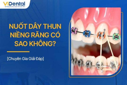 Nuốt Dây Thun Niềng Răng Có Sao Không? Cách Xử Lý Tốt Nhất