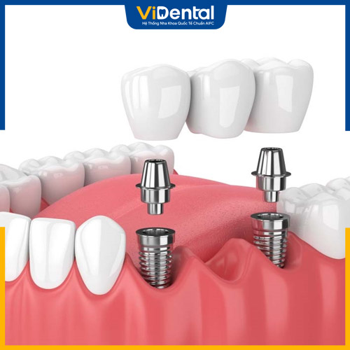 Trồng răng Implant là phương pháp phục hình hiện đại nhất