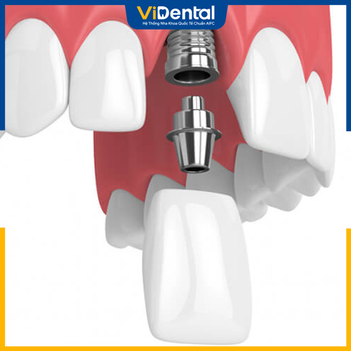 Implant là một trong các phương pháp trồng răng cửa hiện đại