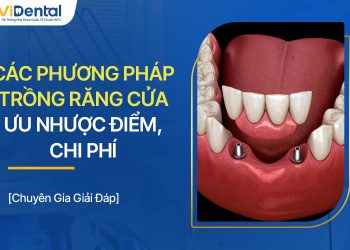 Các Phương Pháp Trồng Răng Cửa: Ưu Nhược Điểm, Chi Phí