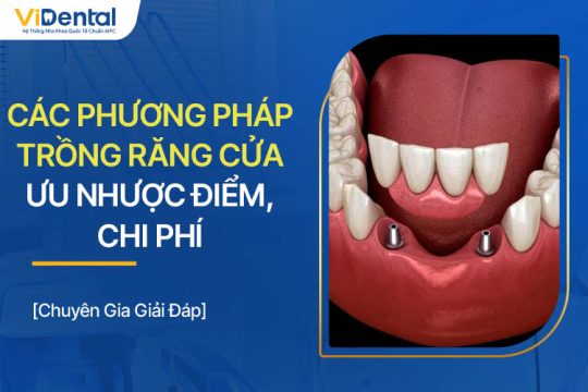 Các Phương Pháp Trồng Răng Cửa: Ưu Nhược Điểm, Chi Phí