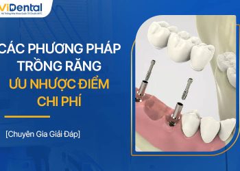 Các Phương Pháp Trồng Răng: Ưu Nhược Điểm, Chi Phí