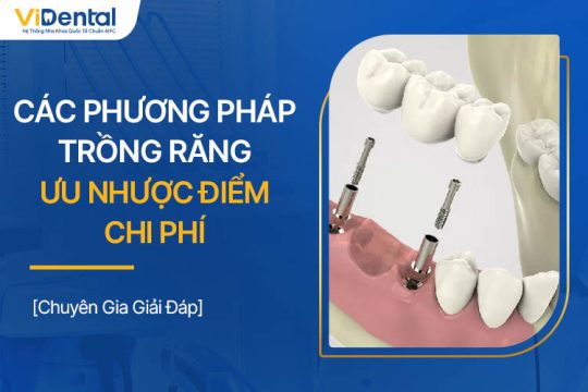 Các Phương Pháp Trồng Răng: Ưu Nhược Điểm, Chi Phí