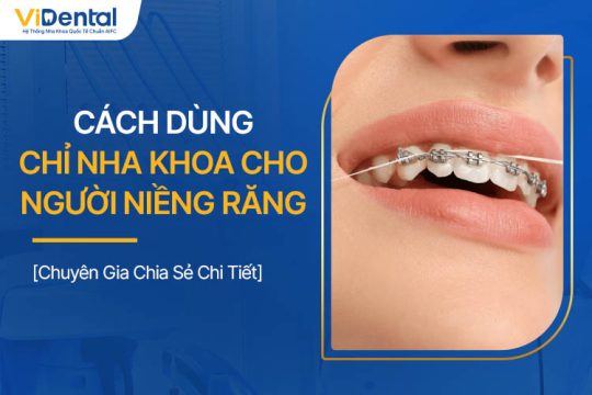 Cách Dùng Chỉ Nha Khoa Khi Niềng Răng Chuyên Gia Chia Sẻ