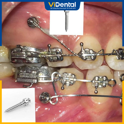 Cắm minivis có thể gây đau nhưng không quá nghiêm trọng