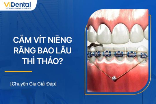 Cắm Vít Niềng Răng Bao Lâu Thì Tháo? Cắm Lâu Có Sao Không?