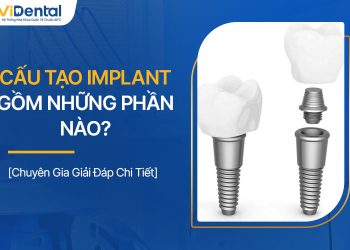 Cấu Tạo Implant Gồm Những Phần Nào? Tiêu Chí Lựa Chọn