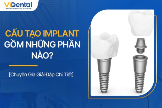 Cấu Tạo Implant Gồm Những Phần Nào? Tiêu Chí Lựa Chọn