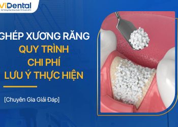 Ghép Xương Răng Là Gì? Quy Trình, Chi Phí, Lưu Ý Thực Hiện