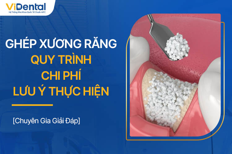 Ghép Xương Răng Là Gì? Quy Trình, Chi Phí, Lưu Ý Thực Hiện