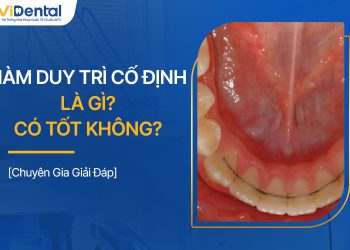 Hàm Duy Trì Cố Định Là Gì? Ưu Nhược Điểm, Chi Phí