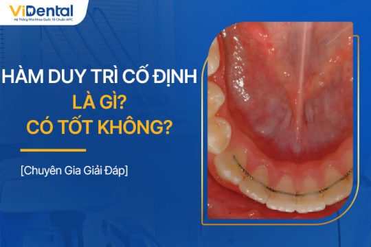 Hàm Duy Trì Cố Định Là Gì? Ưu Nhược Điểm, Chi Phí