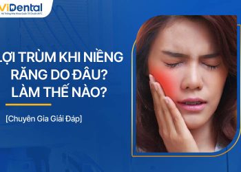 Lợi Trùm Khi Niềng Răng Do Đâu? Làm Thế Nào Để Xử Lý?