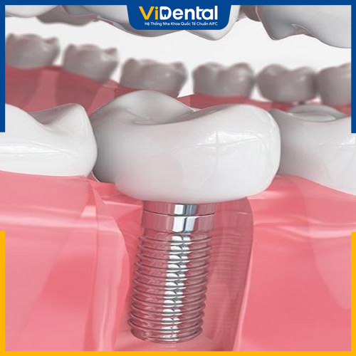 Trồng răng Implant là giải pháp hiệu quả khi mất răng số 7