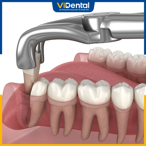 Nhổ răng số 8 thường không cần trồng lại mà vẫn đảm bảo chức năng