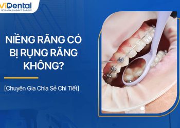 Niềng Răng Có Bị Rụng Răng Không? Cần Lưu Ý Gì?