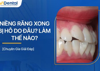 Niềng Răng Xong Bị Hô Do Đâu? Phải Làm Thế Nào?