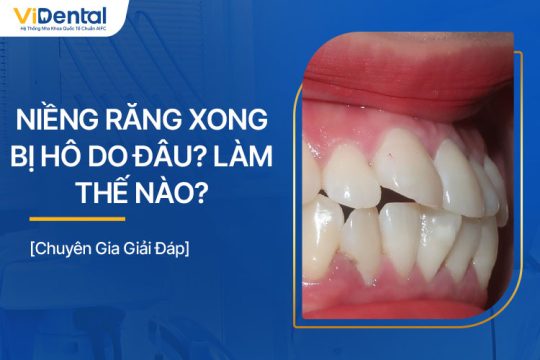 Niềng Răng Xong Bị Hô Do Đâu? Phải Làm Thế Nào?