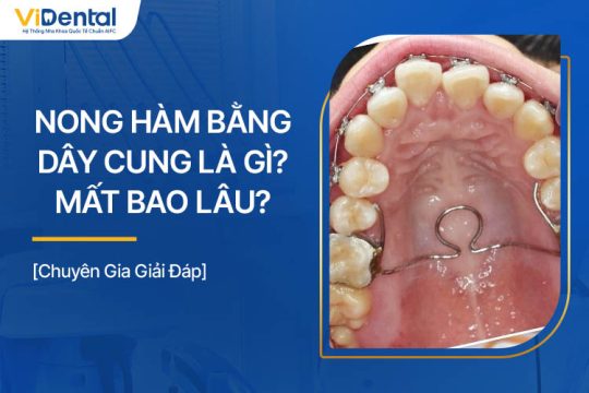 Nong Hàm Bằng Dây Cung Là Gì? Mất Bao Lâu Để Hoàn Thành?