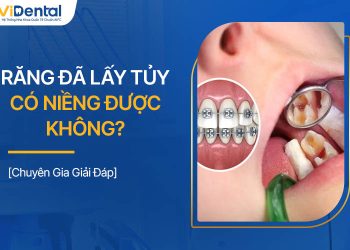 Răng Đã Lấy Tủy Có Niềng Được Không? Chuyên Gia Giải Đáp