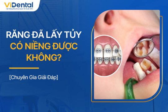 Răng Đã Lấy Tủy Có Niềng Được Không? Chuyên Gia Giải Đáp