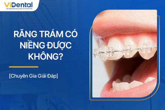 Răng Trám Có Niềng Được Không? Chuyên Gia Giải Đáp