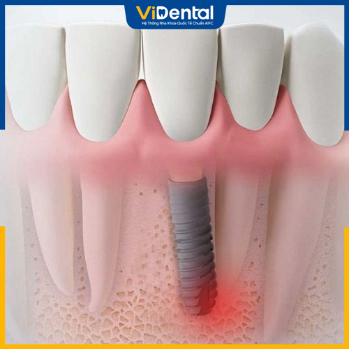 Nếu thực hiện sai kỹ thuật, bạn có thể bị viêm quanh trụ Implant