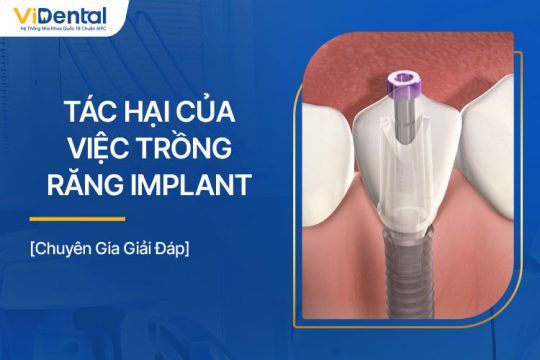 Tác Hại Của Việc Trồng Răng Implant Bạn Cần Chú Ý