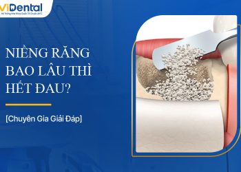 Chi Phí Ghép Xương Implant Là Bao Nhiêu? Bảng Giá Cụ Thể