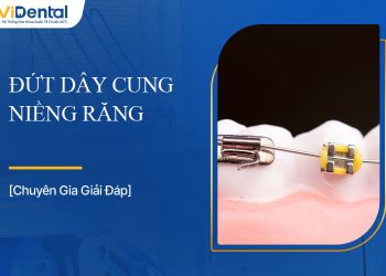 Đứt Dây Cung Niềng Răng Do Đâu, Có Sao Không?