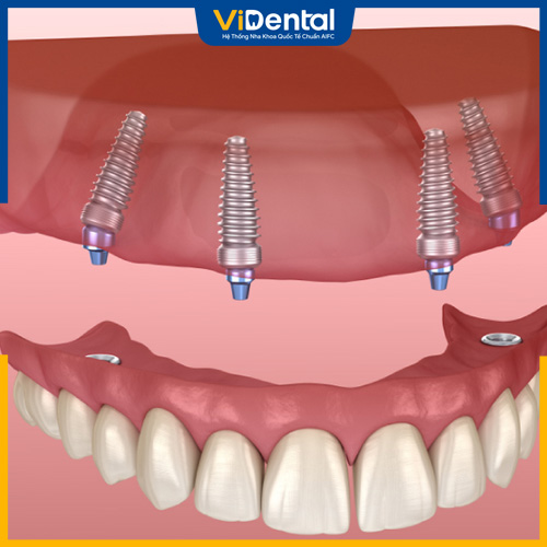 Hàm tháo lắp trên implant gắn các trụ implant