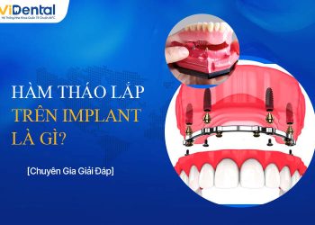 Hàm Tháo Lắp Trên Implant Là Gì, Ưu Nhược Điểm Thế Nào?