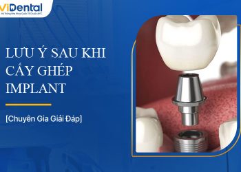 Lưu Ý Sau Khi Cấy Ghép Implant Để Răng Miệng Khỏe Mạnh