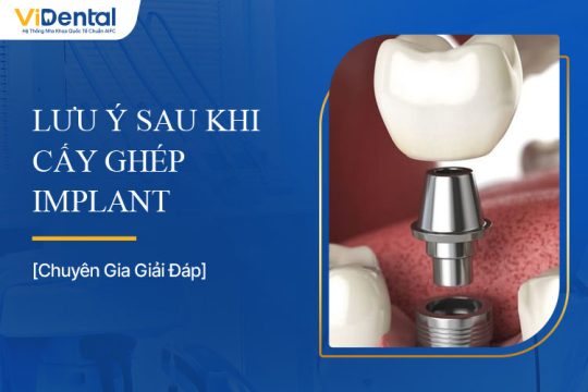 Lưu Ý Sau Khi Cấy Ghép Implant Để Răng Miệng Khỏe Mạnh