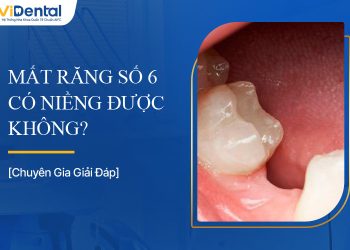 Mất Răng Số 6 Có Niềng Được Không, Dùng Phương Pháp Nào?