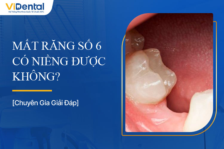 Mất Răng Số 6 Có Niềng Được Không, Dùng Phương Pháp Nào?