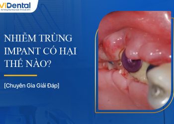 Tìm Hiểu Nhiễm Trùng Implant Và Cách Xử Lý Hiệu Quả, An Toàn