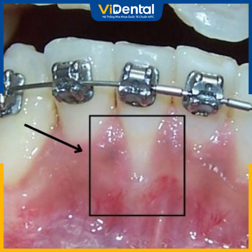 Niềng răng bị tiêu xương do lực kéo hoặc cách chăm sóc răng miệng