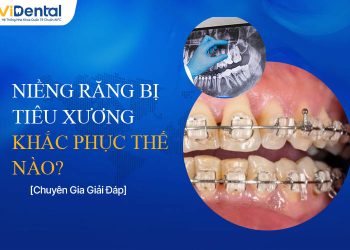 Niềng Răng Bị Tiêu Xương Do Đâu? [Giải Đáp Từ Chuyên Gia]