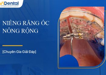 Niềng Răng Ốc Nông Rộng Là Gì, Chi Phí Thực Hiện Bao Nhiêu?