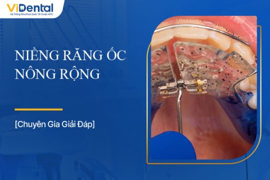 Niềng Răng Ốc Nông Rộng Là Gì, Chi Phí Thực Hiện Bao Nhiêu?