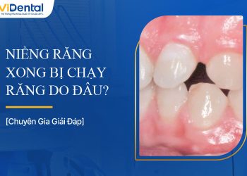 Niềng Răng Xong Bị Chạy Răng Phải Làm Sao?