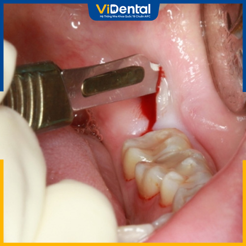 Nhổ răng khôn nhằm hạn chế các rủi ro cho răng miệng