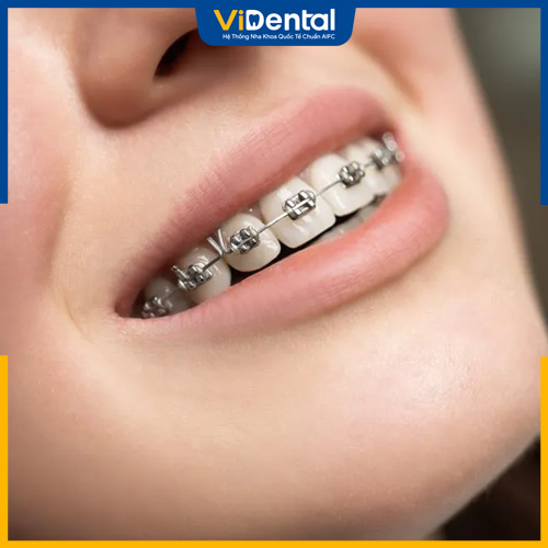 Có thể lựa chọn niềng răng mắc cài kim loại hoặc sứ, niềng trong suốt