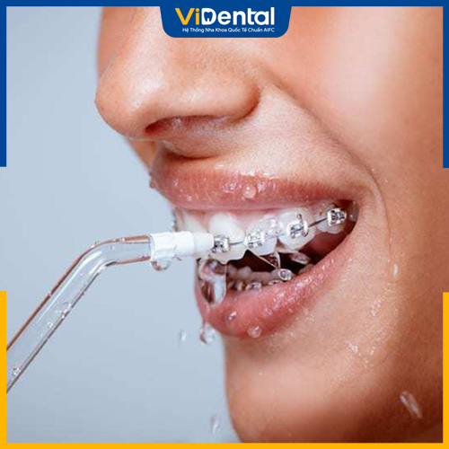 Nên sử dụng tăm nước để làm sạch răng